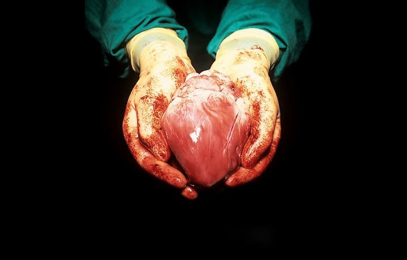 Heart transplant