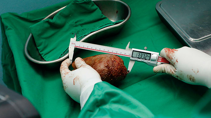 Sri Lanka Army doctors removed the World's Largest Kidney Stone