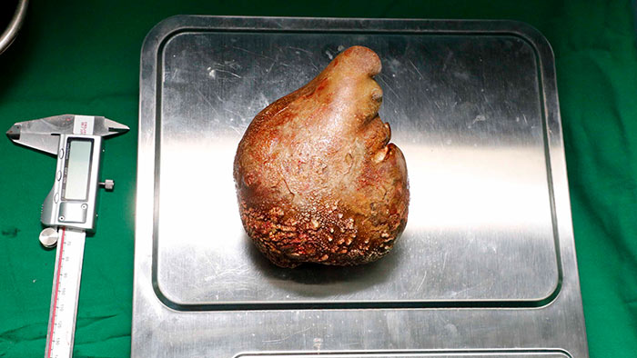 Sri Lanka Army doctors removed the World's Largest Kidney Stone